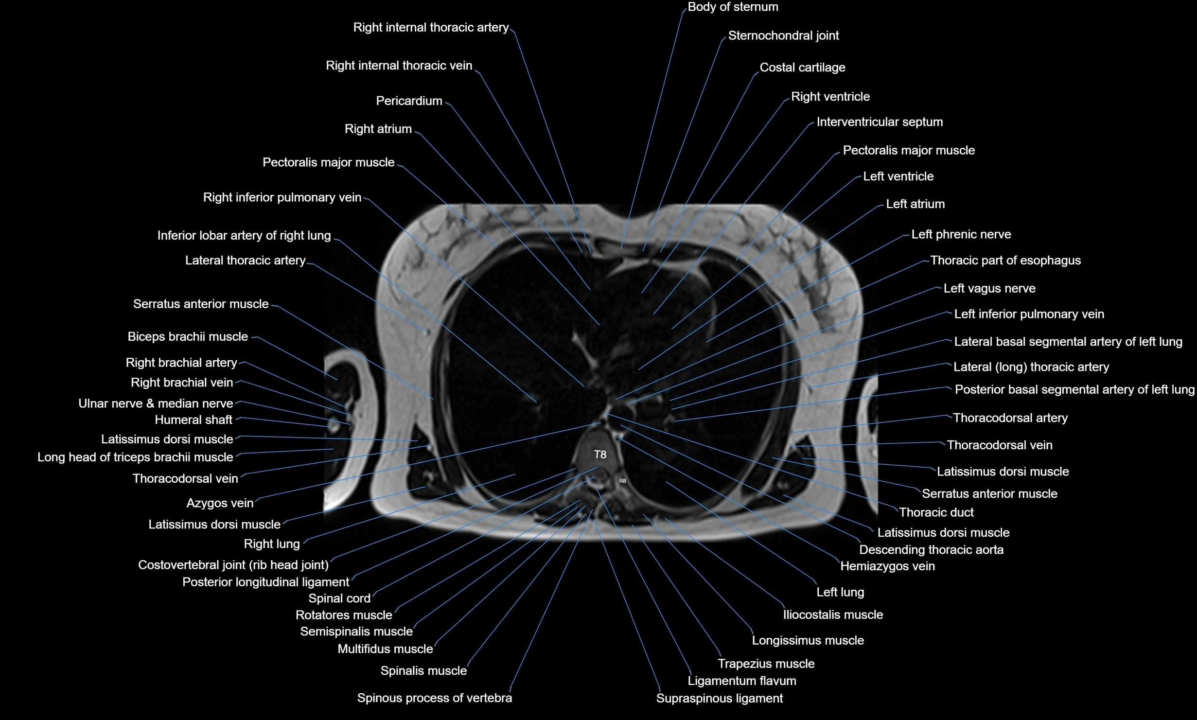 MRI chest axial  cross sectional anatomy 3T radiology  image-img-00001-00027.webp